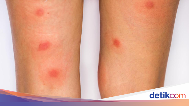 Kenali Ciri-ciri Gigitan 4 Serangga Ini pada Kulit (2)