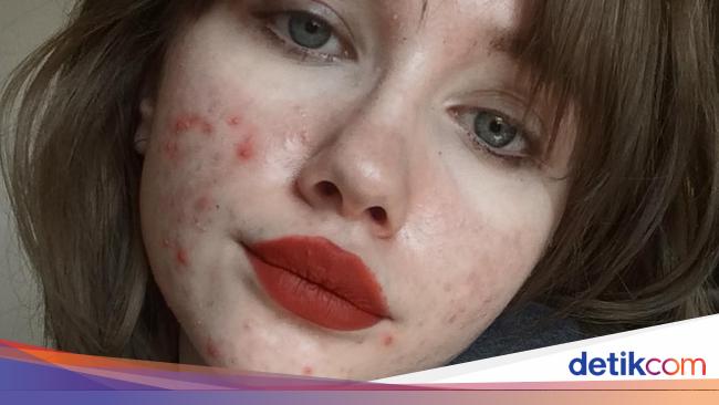 Foto Wajah Berjerawat dengan Pesan Inspiratif Ini Banjir Pujian Netizen