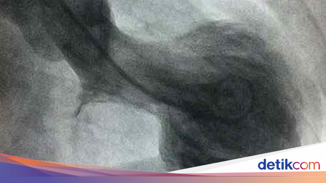 Foto Rontgen Jantung Pasien yang Diduga Kena Sindrom Patah Foto Rontgen Jantung Pasien yang Diduga Kena Sindrom Patah
