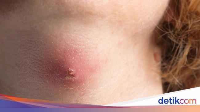 Jangan Dipencet Ini Cara Tepat Tangani Bisul