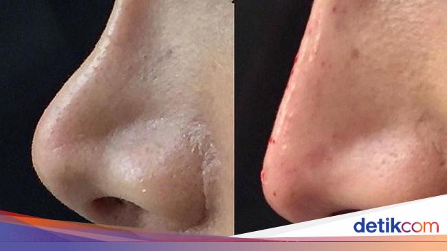 Faktor Penyebab Hidung Pesek Dan Tips Agar Terlihat Mancung 1168