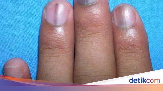 9 Contoh Tanda Penyakit Yang Bisa Muncul Di Kuku