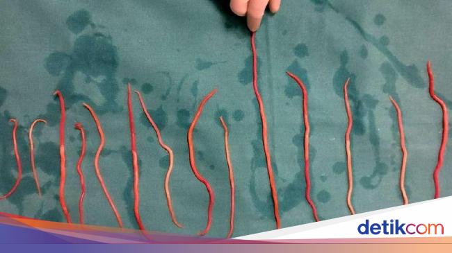 Balita Sukabumi Meninggal dengan Tubuh Dipenuhi Cacing, RSUD Ungkap Kondisinya