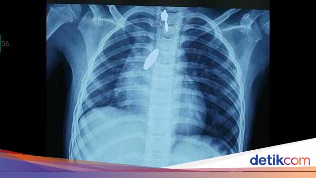 Magnet Masuk Ke Paru Paru Dokter Gunakan Cara Ini Untuk Mengeluarkannya