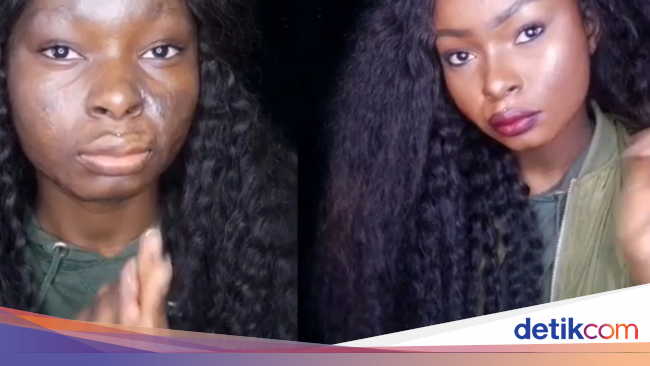 Alami Luka Bakar Gadis Ini Jadi Viral Karena Kemampuan Alami Luka Bakar Gadis Ini Jadi Viral Karena Kemampuan