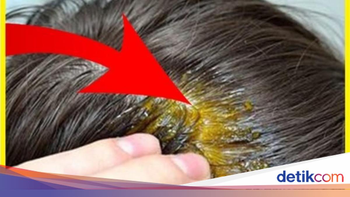 Rambut Anda Akan Tumbuh Lebat Jika Menggunakan Ini