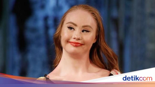 Mimpi Besar Model Down Syndrome Bisa Cetak Sejarah Di Show Victorias