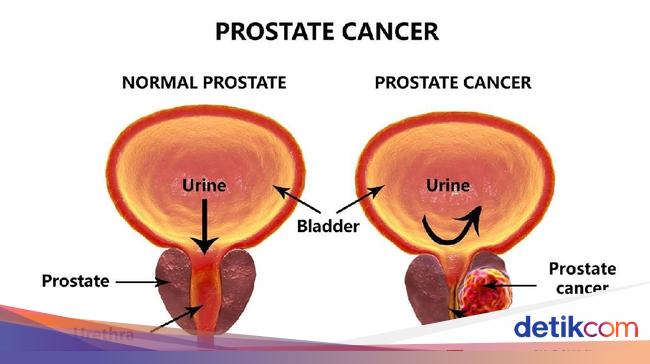 Ada Kanker Prostat Dan Pembesaran Prostat Apa Bedanya
