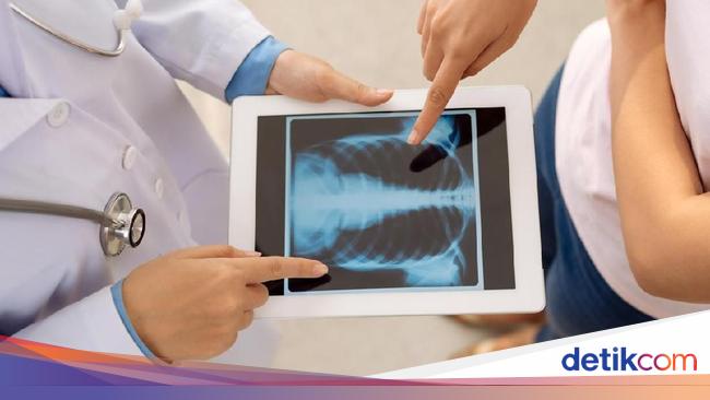 Hari Radiografi Sedunia 8 November, Peringati Penemuan Sinar-X