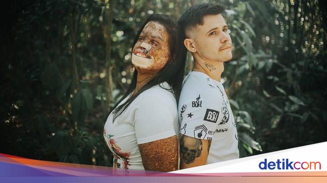 Tunangan Dengan Wanita Idap Penyakit Langka Kisah Cinta Pria Ini Viral