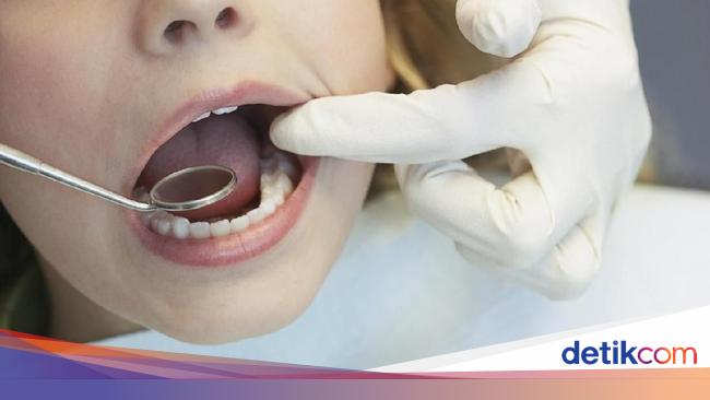 Meski Dipasang Permanen Veneer Gigi Tetap Harus Dirawat Meski Dipasang Permanen Veneer Gigi Tetap Harus Dirawat