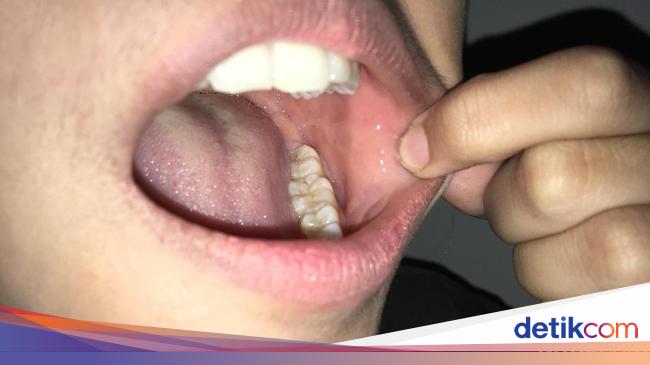 Lidah Bengkak Memerah Waspada Lidah Stroberi