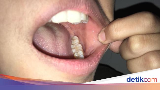 Gejala Baru Covid 19 Studi Temukan Ruam Mulut Di Pasien Corona