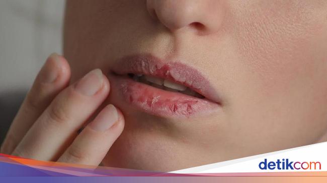 Gejala Kolesterol yang Bisa Muncul di Mulut, Jarang Diketahui