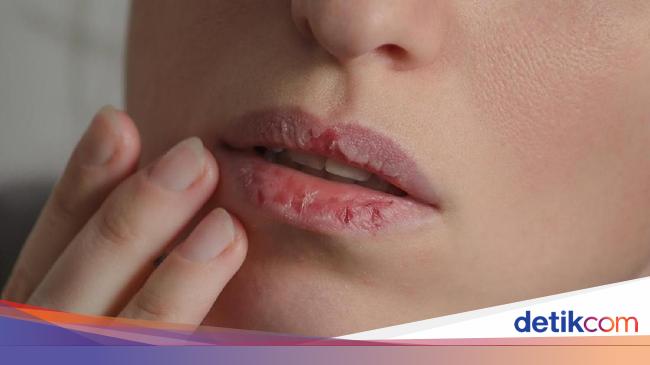 Jangan Dijilat Ini Yang Sebaiknya Dilakukan Jika Bibir Kering Saat Puasa