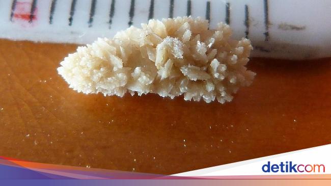 8 Gejala Batu Ginjal yang Perlu Diketahui dan Penyebabnya