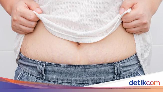 Kista Ovarium Sebesar 18 Kg Tumbuh di Perut Wanita Ini Sampai Sulit Napas