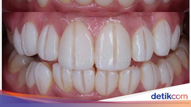 Berapa Harga Veneer Gigi Yang Biasa Dikerjakan Dokter Di Klinik