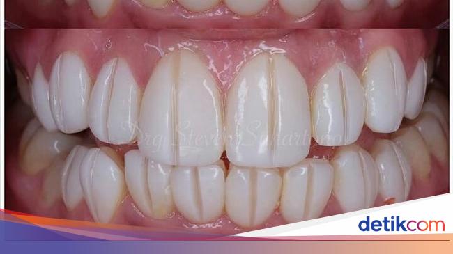 Berapa Harga Veneer Gigi Yang Biasa Dikerjakan Dokter Di Klinik Berapa Harga Veneer Gigi Yang Biasa Dikerjakan Dokter Di Klinik