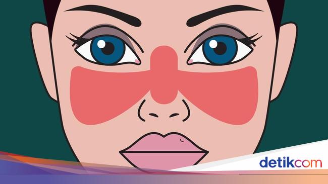 Mengenal Penyakit Lupus Gejala Penyebab Pencegahan Dan