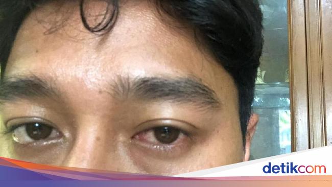 Obat Sakit Mata Merah Untuk Anak Alodokter