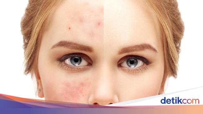 7 Cara Menghilangkan Bekas Luka Yang Manjur Dan Bikin Pede Lagi