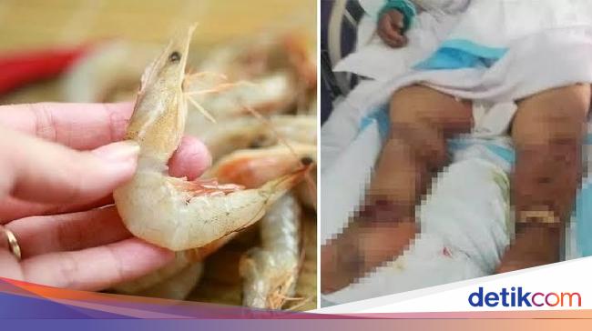 Seram Kena Cangkang Udang Pria Ini Terluka Tangannya Dan Tewas