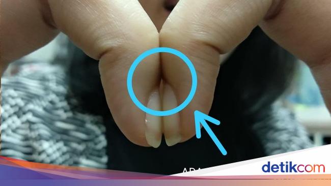 Viral Tes Dempetkan Dua Kuku Bisa Ungkap Risiko Kanker Paru, Percaya?