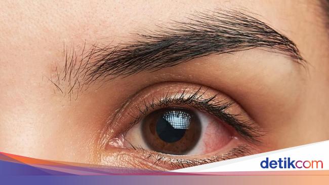 5 Obat Sakit Mata Alami Serta Penyebabnya
