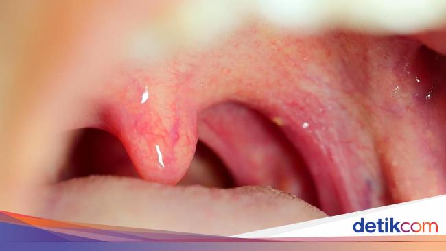 Ciri-ciri Amandel Normal dan Tidak Normal serta Cara Mengobatinya