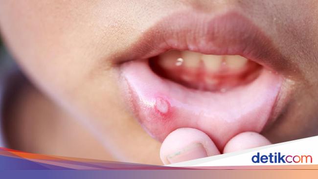 10 Obat Sariawan Alami Yang Ampuh Untuk Dewasa Dan Anak