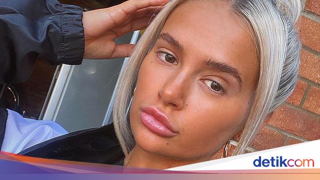 Penyesalan Artis Inggris  Suntik Filler di Usia 18 Tahun 