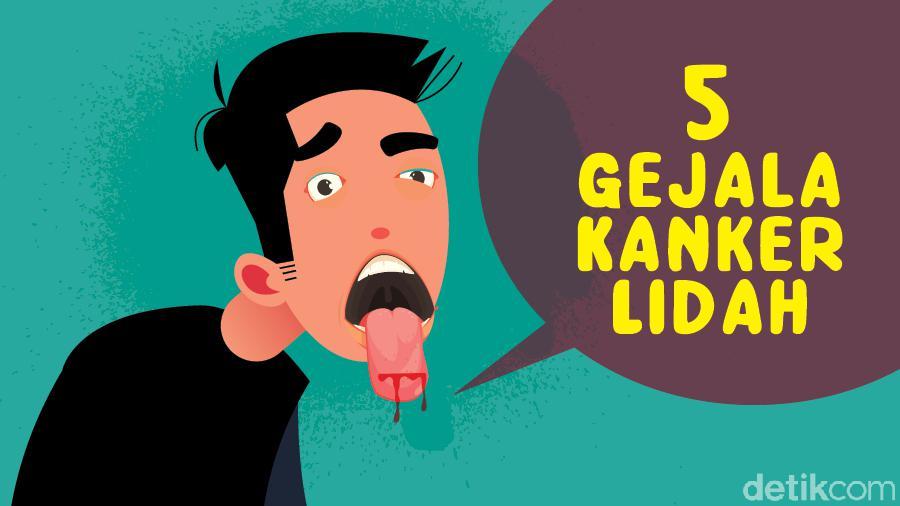 5 Gejala Kanker Lidah, Mati Rasa Hingga Sariawan Tak Sembuh-sembuh