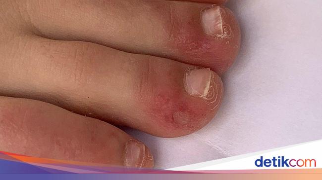 Pakar Terkejut Melihat Ruam Kulit Pada Pasien Covid 19 Gejala Baru Corona