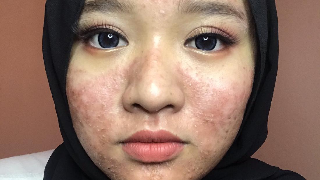 Rahasia Makeup Flawless untuk Kulit Berjerawat: Tampil Percaya Diri Tanpa Memperparah Kondisi
