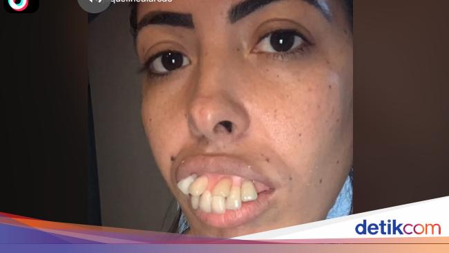 Foto Transformasi Wanita Bergigi Tonggos Ini Viral Netizen Ternyata