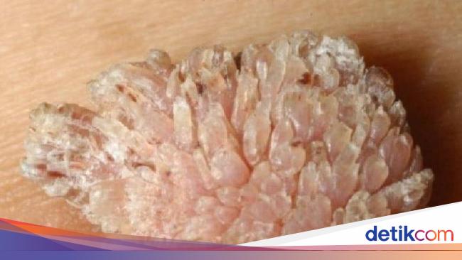 Jika Kutil Muncul pada Leher atau Punggung, Artinya Tubuhmu