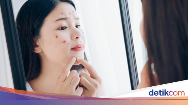 Jangan Anggap Remeh Jerawat Yuk Kenali Jenis Jerawat Kamu