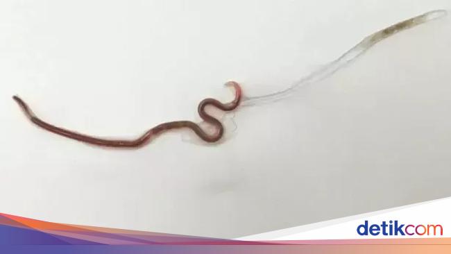 Hi Makan Sashimi Wanita Ini Temukan Cacing Hidup Di Mulutnya