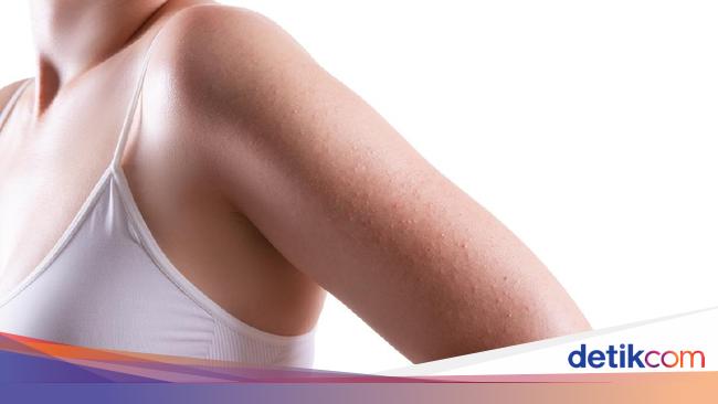 Jerawat Di Lengan Penyebab Dan Cara Mengatasinya