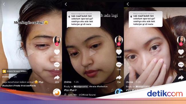 Viral Kista Di Mata Disangka Bintitan Tak Tahunya Kalazion Dan Harus Operasi