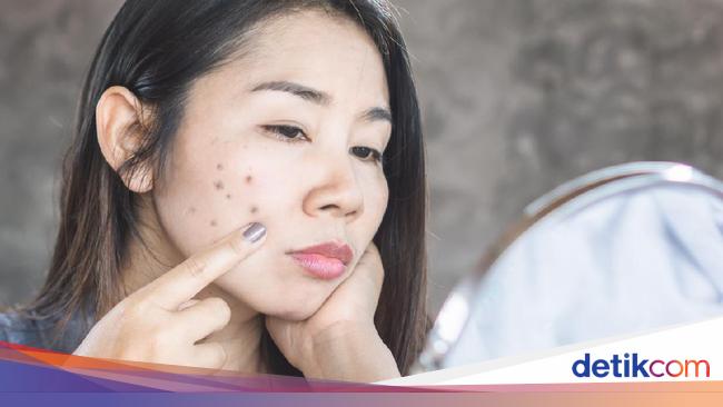 Skincare Menghilangkan Noda Hitam