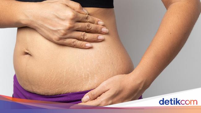 5 Penyebab Stretch Mark di Paha dan Cara Menyamarkannya