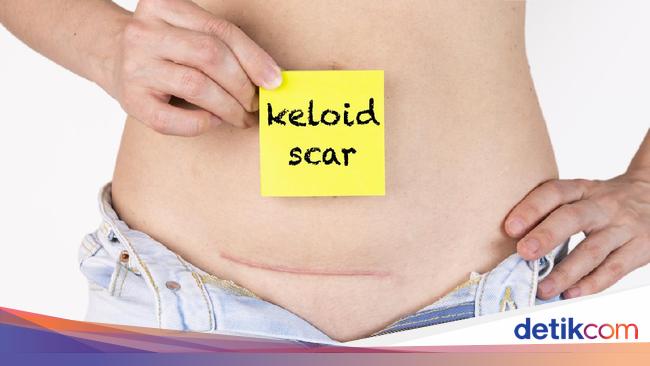 Bekas Caesar Rapi Muncul Keloid Usai Operasi Caesar? Ini 4 Cara Menyamarkannya