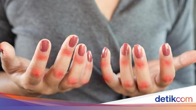 Apa Itu Penyakit Autoimun? Kenali Jenis dan Faktor Risikonya