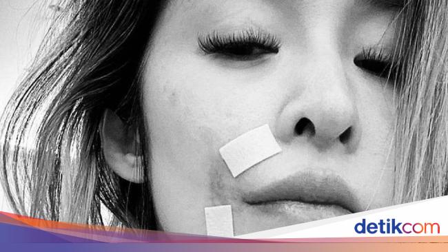 Kisah Artis Cantik yang Wajahnya Digigit Anjing: Aku Menangis Tiap Liat Cermin