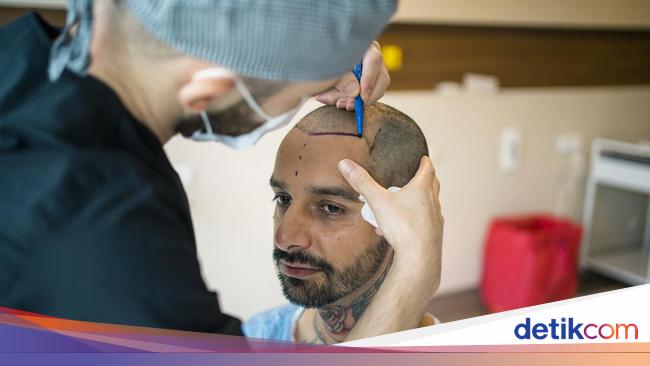 Are Hair Transplants Effective for Baldness?  This is the explanation