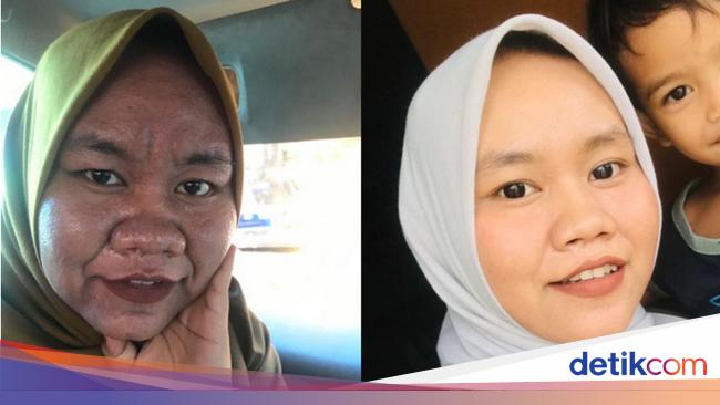 Viral Transformation of a Woman’s Face Changed because of Pregnancy, Shock So This Is