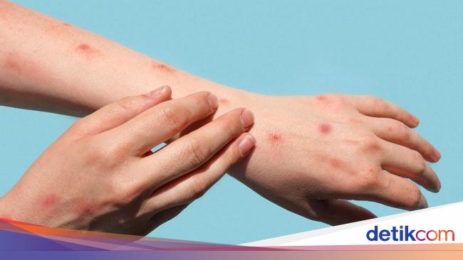 DKI Jakarta Reports 28 Positive Monkey Pox Cases – Latest Updates and Information