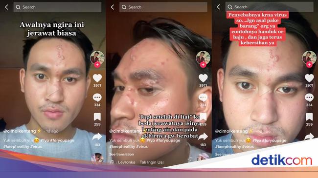 Herpes Zoster Facts, Jakarta Men Complained After Suspecting Acne